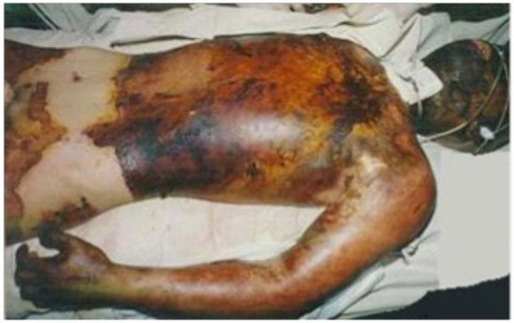 Burns in the Emergency Department A High-Yield, Final FRCEM SBA–Focused Guide to Assessment and Management